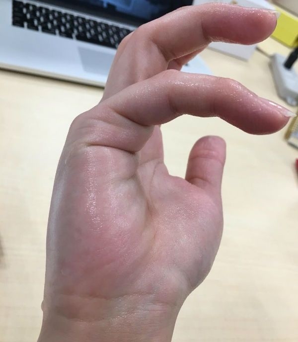 <参考>多汗症患者の手の汗