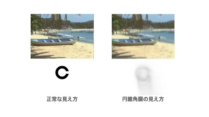 円錐角膜の見え方