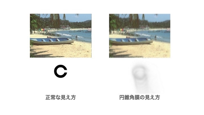 円錐角膜の見え方