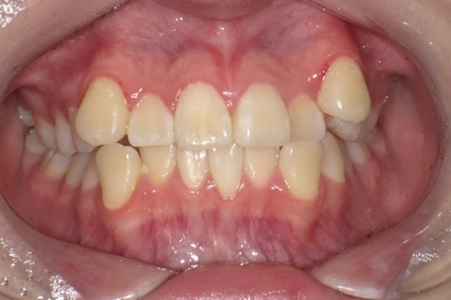 日本人に最適化した歯列矯正治療法「JET system」により、 7か月で治療完了