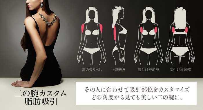 ベイザー脂肪吸引20,000症例突破記念・二の腕カスタム脂肪吸引キャンペーンを実施中