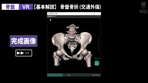 股関節(骨盤) MPR・VR