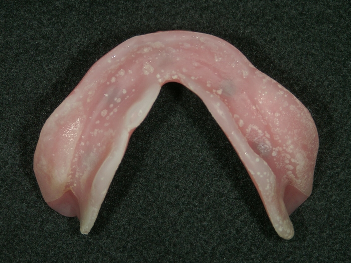 汚れが蓄積された総入れ歯