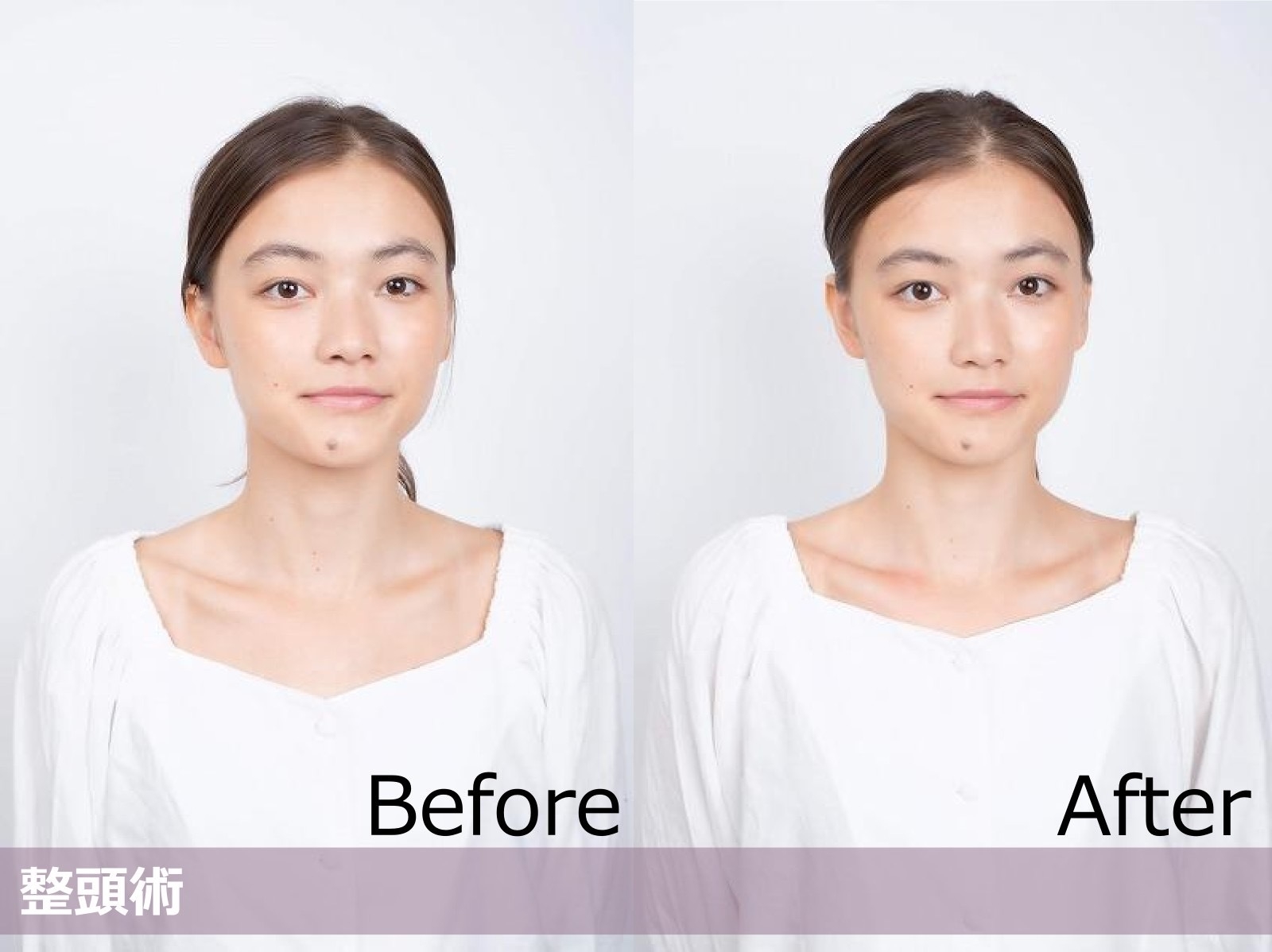 整頭術ビフォーアフター(1)
