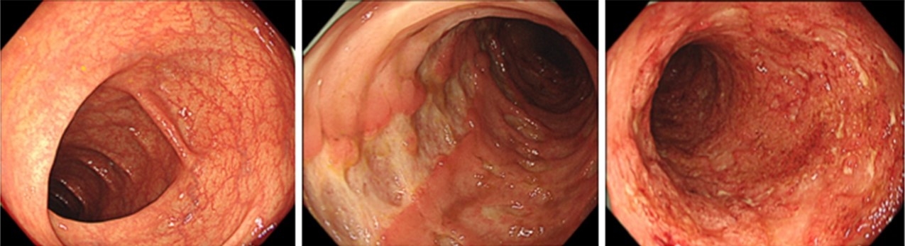 正常な大腸粘膜(左)、クローン病の大腸粘膜(中央)、潰瘍性大腸炎の大腸粘膜(右)