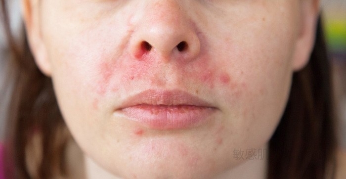 脂漏性皮膚炎の症状例