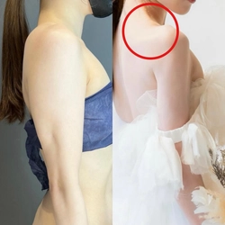 新時代の“肩ライン整形”が日本上陸！銀座のAVAN TOKYOで 肩甲骨の張り出しを根本改善する【肩甲骨骨削り術】を提供開始