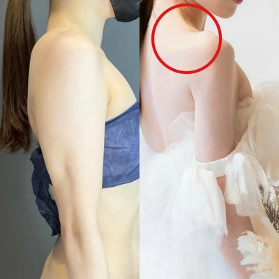 新時代の“肩ライン整形”が日本上陸！銀座のAVAN TOKYOで 肩甲骨の張り出しを根本改善する【肩甲骨骨削り術】を提供開始