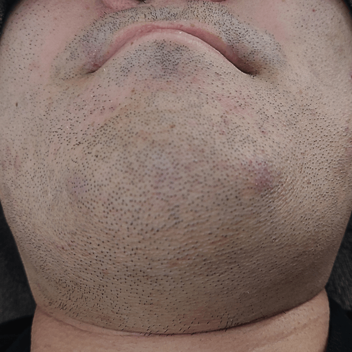 [ヒゲ脱毛施術中の男性写真]