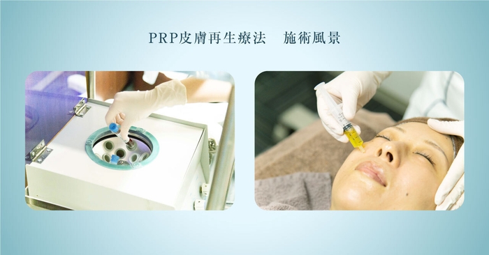 PRP皮膚再生療法 施術風景