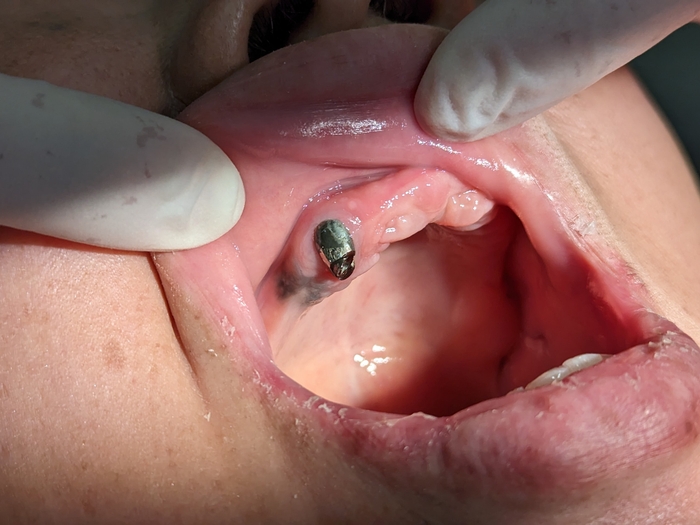 片顎だけ総入れ歯の人も多い