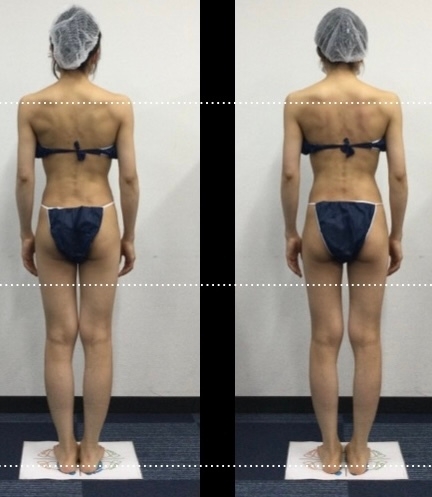 左:施術前 右:施術後