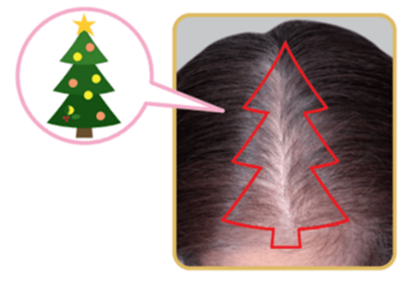 クリスマスツリーのような三角形に脱毛する進行パターン