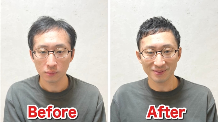 M字薄毛をカットで改善(5)