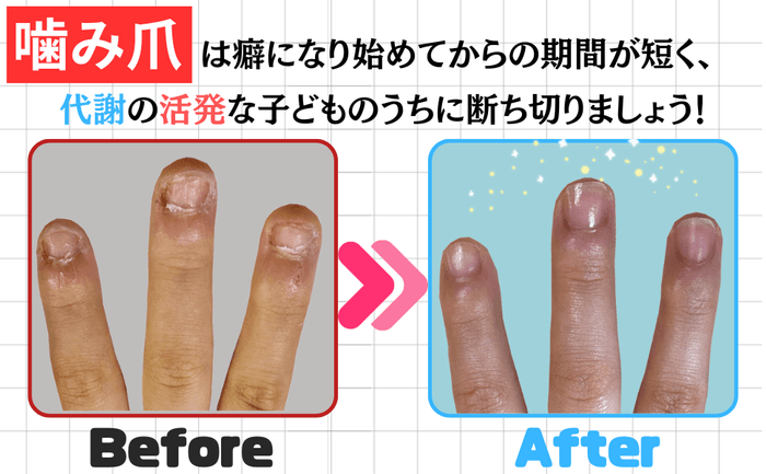 バイバイ！噛み爪_Before＆After