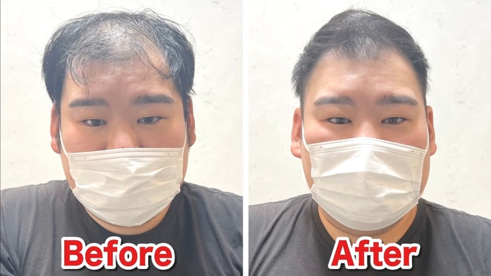 U字薄毛をカットで改善(3)