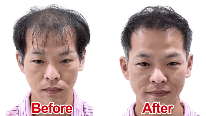 U字薄毛をカットで改善(1)