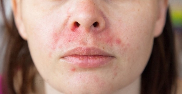 脂漏性皮膚炎　酒さ