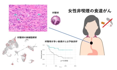 女性非喫煙者の食道がんの特徴