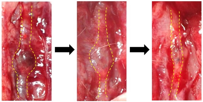 左：形成された腹部大動脈瘤、中央：トリカプリン投与後経過、右：トリカプリン投与により腹部大動脈瘤が縮小