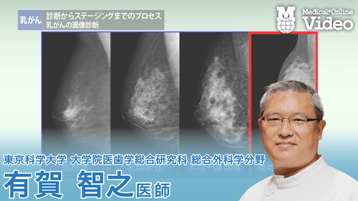 乳がん 診断からステージング