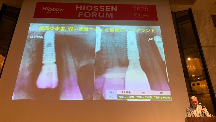 図2：赤坂歯科・矯正歯科クリニック 米本 久史先生による『HIOSSENの新たな選択肢：NHインプラントの臨床的利点と適応症例』の講義風景
