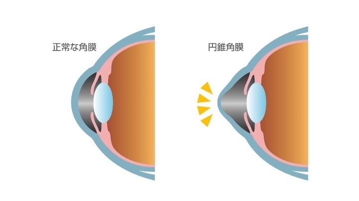 円錐角膜の模式図