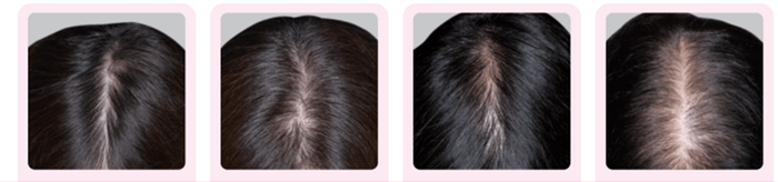 分け目の透け感(壮年性脱毛症)の頭髪写真