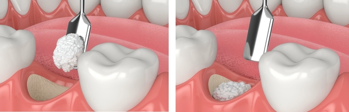 幹細胞培養上清液した骨再生インプラント治療