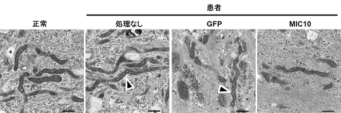 図4　クリステ形成の異常　患者由来線維芽細胞を電子顕微鏡により観察することで、クリステ形成の異常を観察しました（矢印）。また、MIC10を細胞に戻すことで、この異常は回復されました。