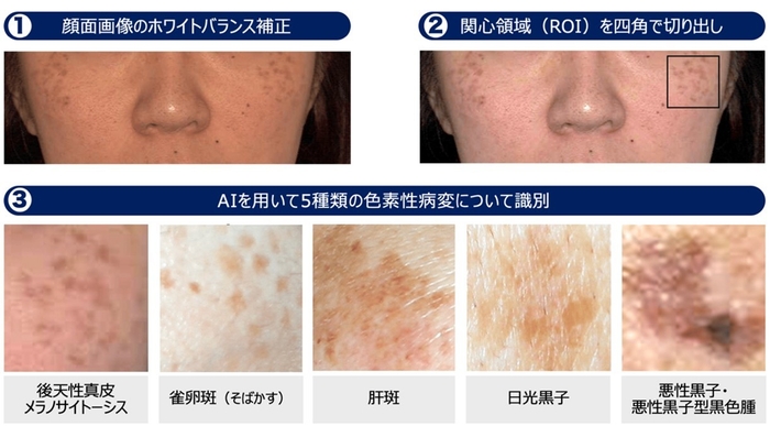 顔面のシミの種類をAIで高精度に識別する手法の流れ