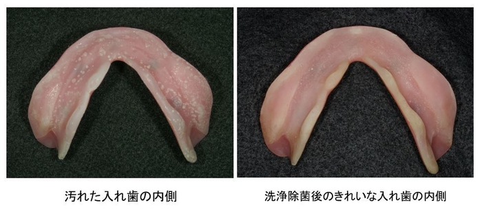 汚れた入れ歯ときれいな入れ歯