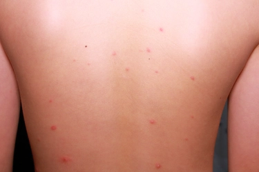 大正健康ナビ、10/29新着情報　 かゆみを伴う水ぶくれの発疹ができる感染症　「水ぼうそう（水痘）」　を公開！