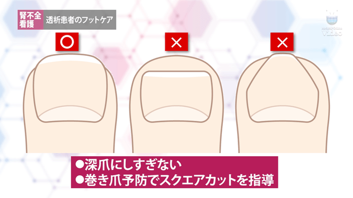 透析患者のフットケア