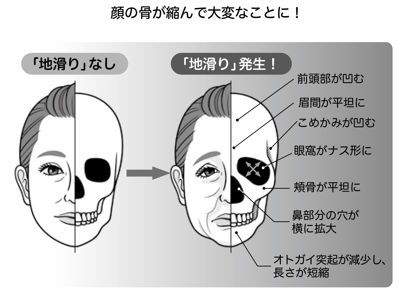 加齢による顔面骨の変化(本文より)