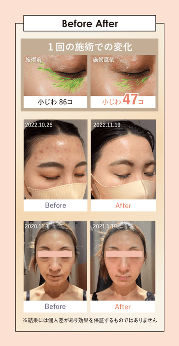 上:ベビースキン施術前後(40代)、 中/下:エステマシンでの施術と商品の飲用・使用による