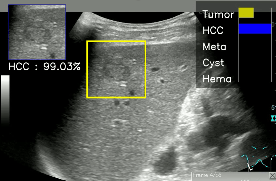 【開発したAIのデモ画面】黄色の四角形で囲まれた部分に肝腫瘤(Tumor)が存在する場合の推定確率、およびこの腫瘤が肝細胞癌(HCC)、転移性肝癌(Meta)、肝嚢胞(Cyst)、肝血管腫(Hema)とした場合の推定確率が、画面右上にグラフで表示されている。また、左上には最も高い推定確率を示す腫瘤の診断名とその推定確率が数値で示される。この画像の場合、肝細胞癌(HCC)である確率が99.03%と表示されている。