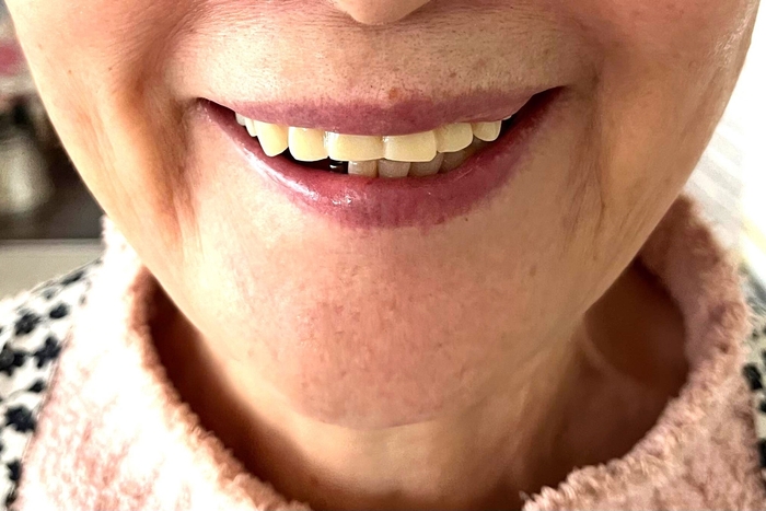 無償提供の白の入れ歯を着けた口元