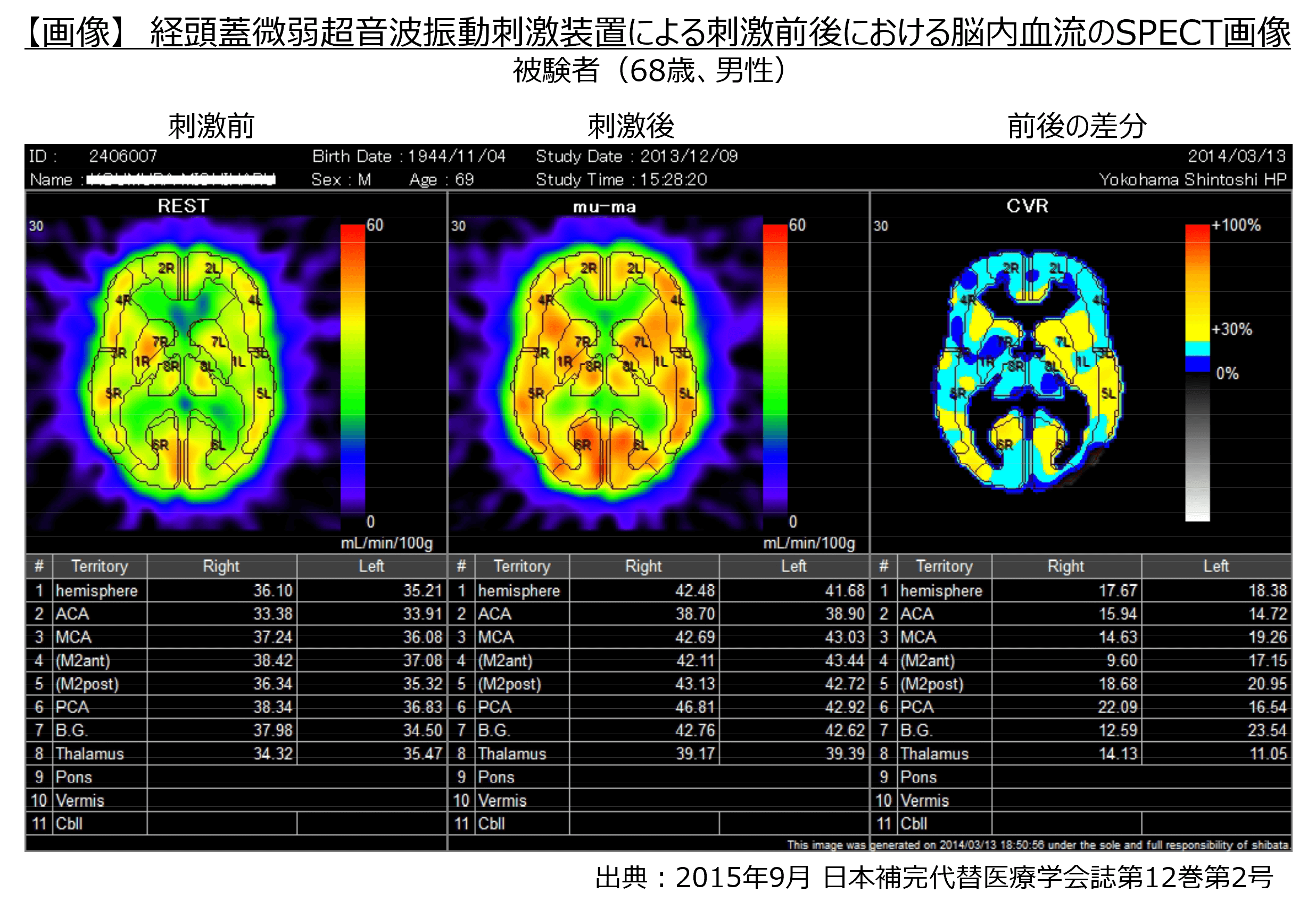 【画像】経頭蓋微弱超音波振動刺激装置による刺激前後における脳内血流のSPECT画像