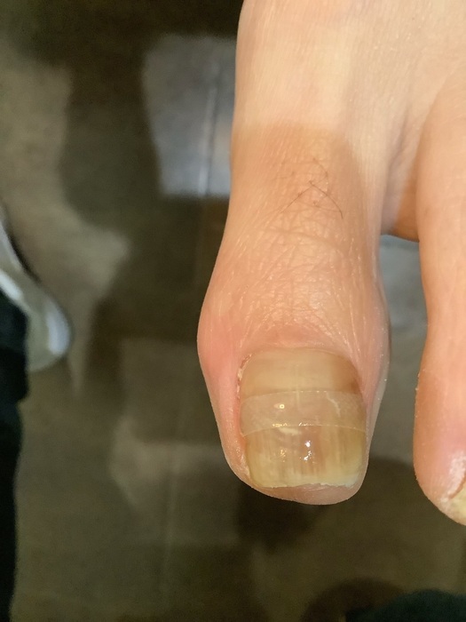 目立たない矯正器具